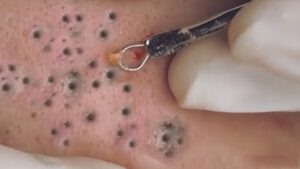 blackheads