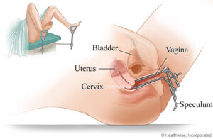 speculum tool